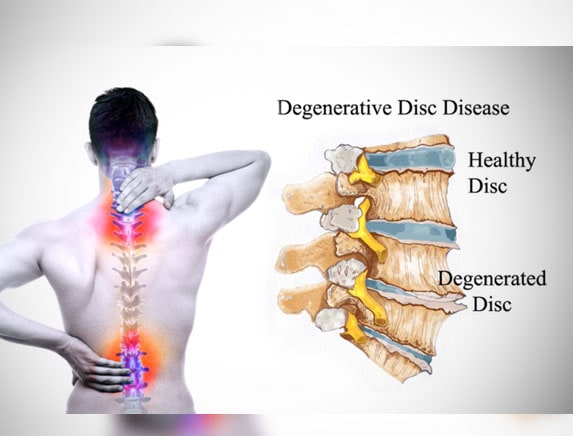 Degenerative Disc Disease Treatment