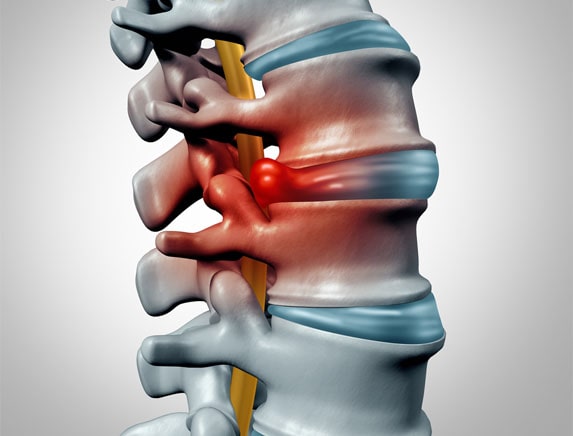 herniated disc